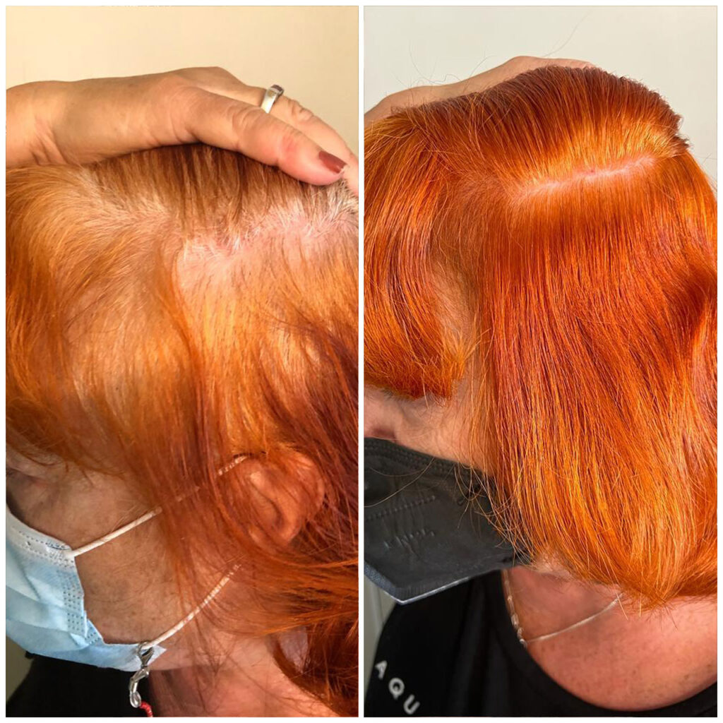 mujer recuperada de alopecia